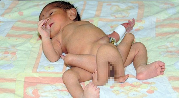 6 bacaklı bebek dehşete düşürdü 2