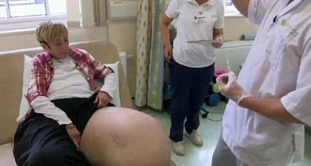 Bu kadının tek bacağı 107 kilo! 6