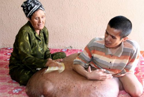 Bacağında 90 kiloluk tümör taşıyor 4
