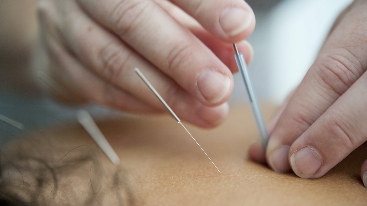 Çocuklarda hiperaktiviteye akupunkturla çözüm