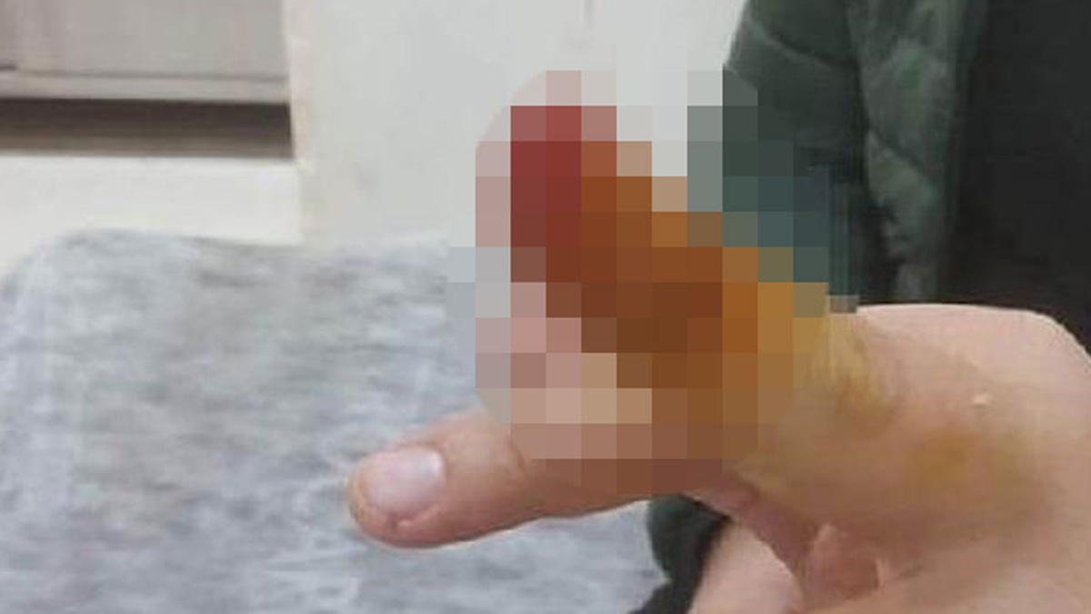 Tartıştığı güvenlik görevlisinin parmağını ısırıp kopardı